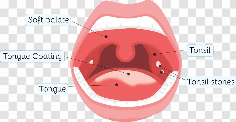Tonsillolith Tonsillitis Throat Health - Sore Transparent PNG