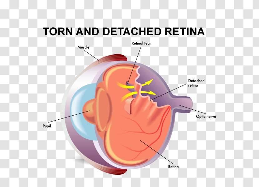 Retinal Detachment Vitreous Body Tears Eye - Flower - Torn Transparent PNG