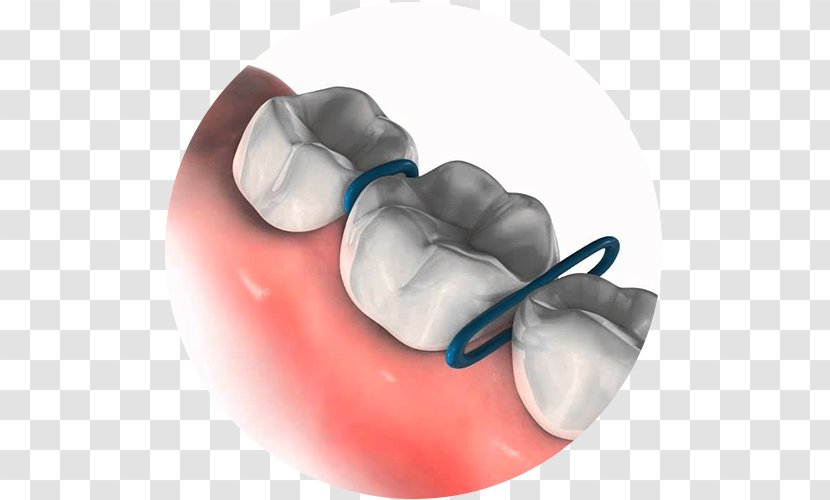 Orthodontics Dental Braces Orthodontic Spacer Technology Rubber Bands Transparent PNG