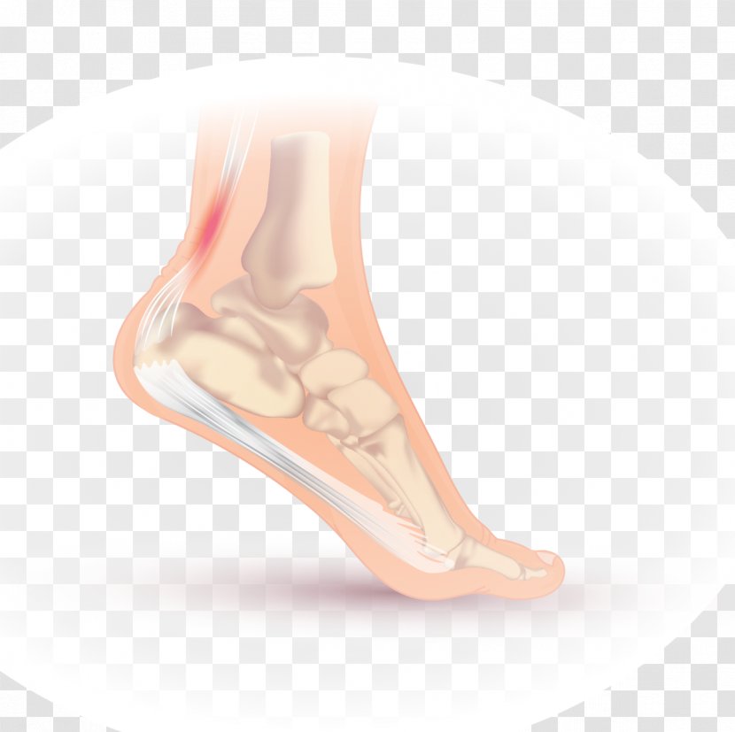 Achilles Tendinitis Tendon - Silhouette - Tree Transparent PNG