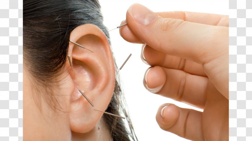 Acupuncture Therapy Alternative Health Services Migraine Medicine - Disease - Omshen Eastern Transparent PNG
