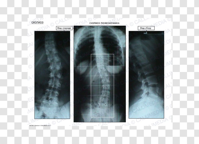 X-ray Radiology Medical Imaging Radiography Stock Photography - Xray - Scoliosis Transparent PNG