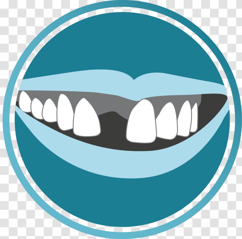 Tooth Dentistry Dental Surgery Implant - Cartoon Transparent PNG