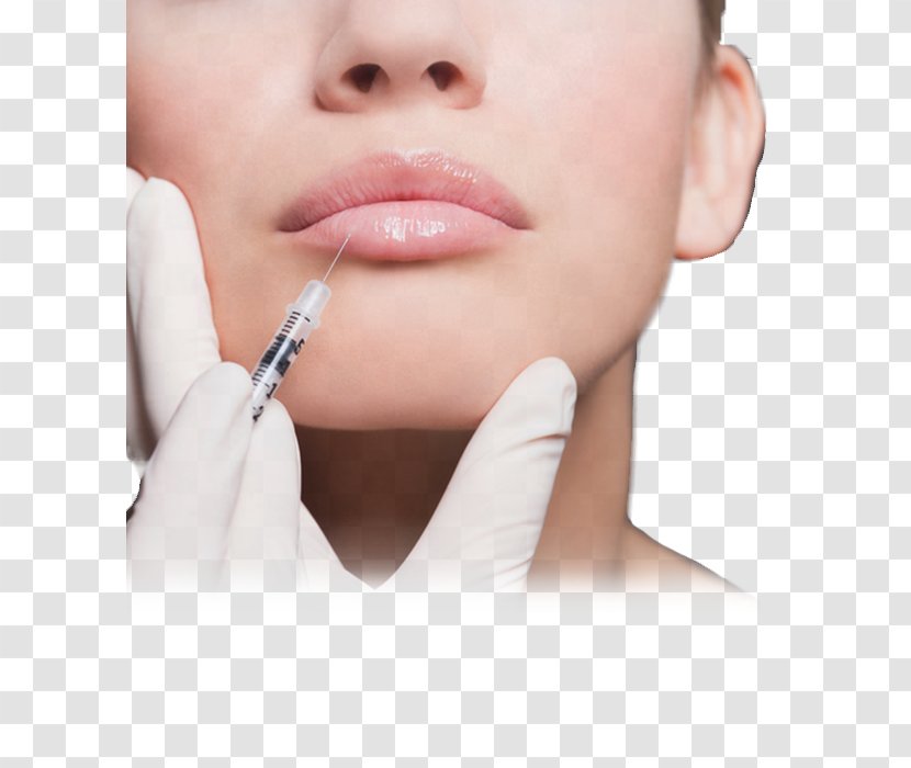 Lip Augmentation Wrinkle Injectable Filler Surgery Skin Care - Hyaluronic Acid - Cosmetic Session Transparent PNG