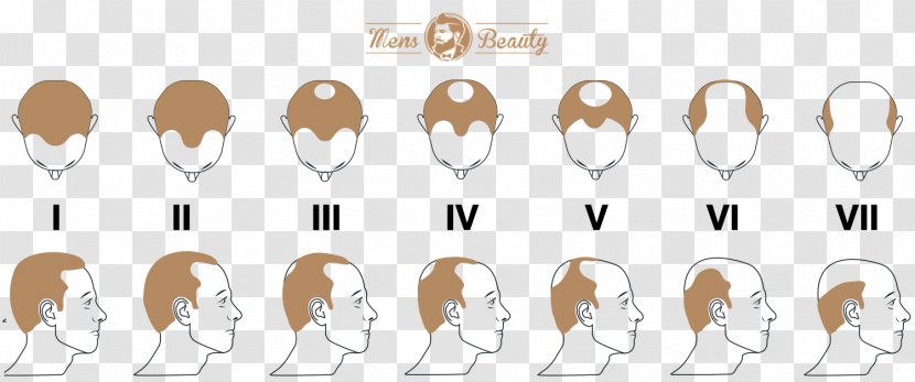 Pattern Hair Loss Transplantation Hamilton–Norwood Scale - Jaw Transparent PNG