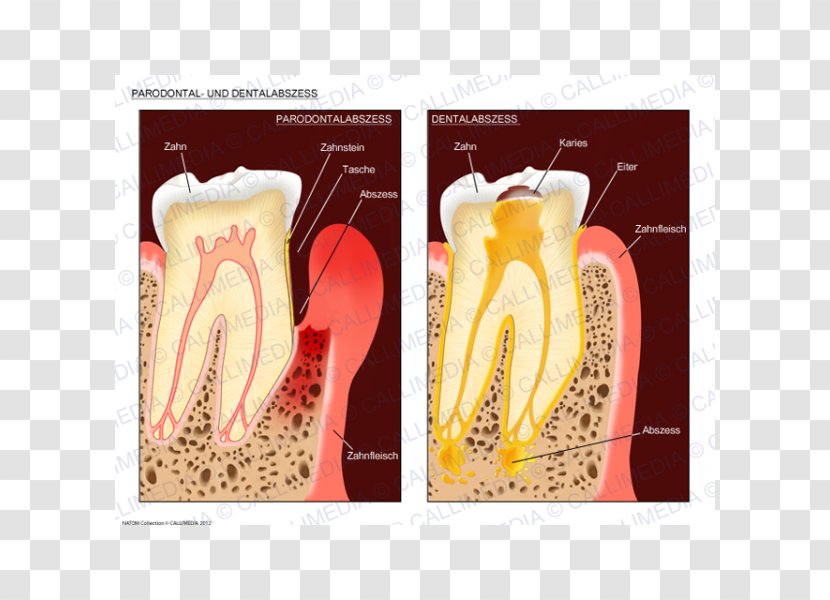 Dental Abscess Periodontal Disease Gingivitis - Carie Transparent PNG