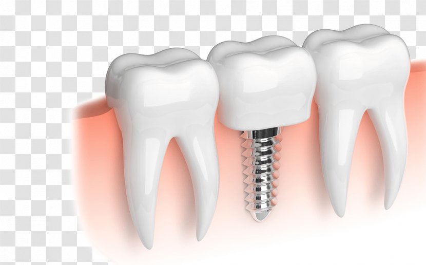 Dental Implant Dentistry Restoration Dentures - Heart - Health Transparent PNG