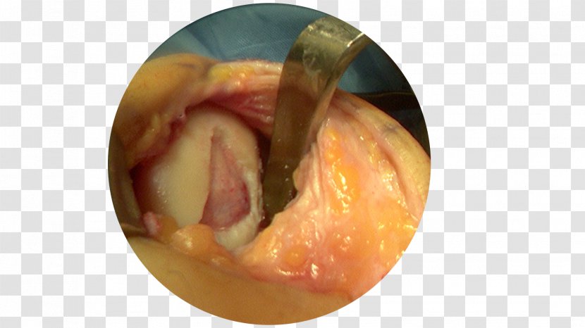 Arthrotomy Microfracture Surgery Arthroscopy Articular Cartilage Damage - Heart - Silhouette Transparent PNG