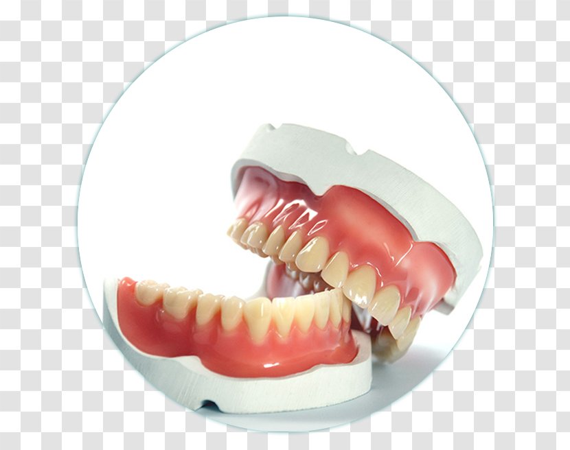 Dentures Prosthesis Dentistry Tooth - Cirurgia Dentista Transparent PNG