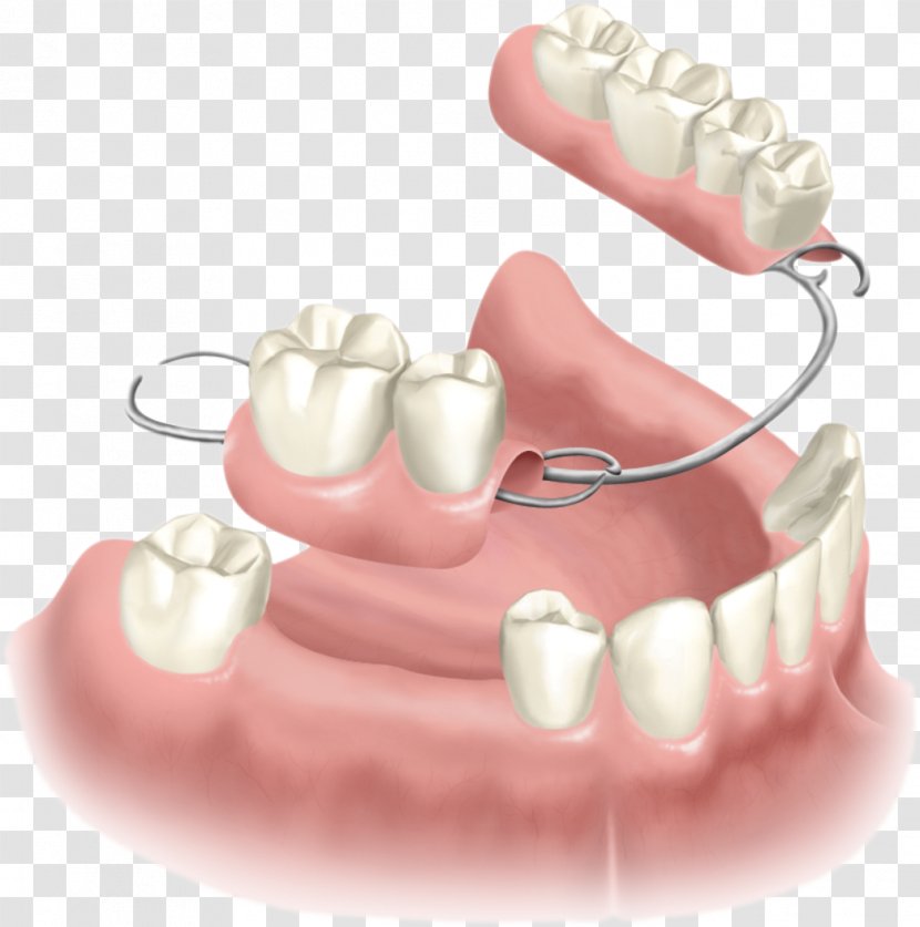 Removable Partial Denture Dentures Dental Implant Dentistry - Chin - Tooth Transparent PNG