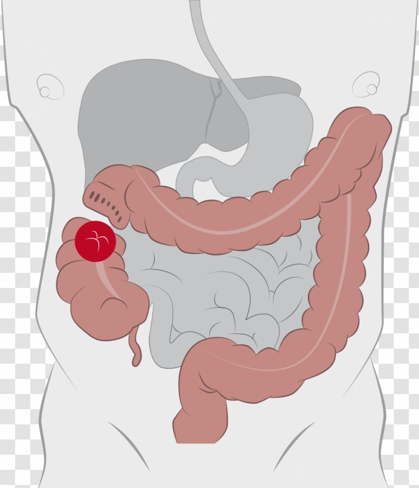 Colostomy Ileostomy Ostomy Pouching System Stoma Ileo-anal Pouch - Flower - Bowel Transparent PNG