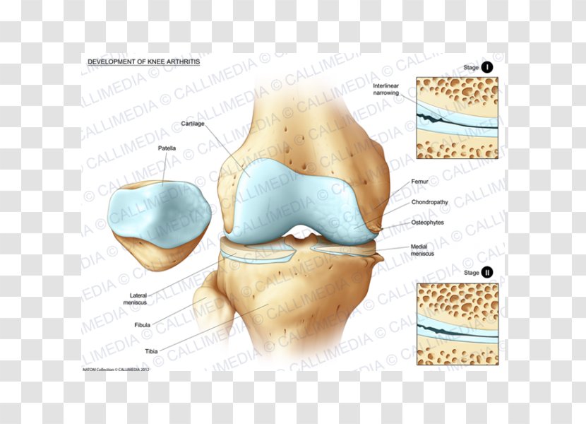 Human Anatomy Knee Body Tibia - Silhouette - Artrosis De Rodilla Transparent PNG