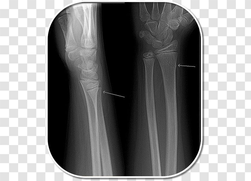 X-ray Shoulder Greenstick Fracture Radiography - Bone - Design Transparent PNG