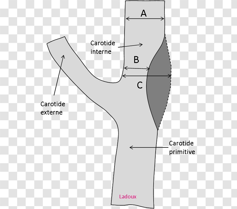 Carotid Artery Stenosis Common Internal Doppler Ultrasonography - Watercolor - Occlusion Transparent PNG