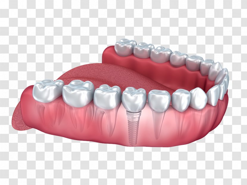 Dental Implant Human Tooth Dentistry - Mouth Transparent PNG