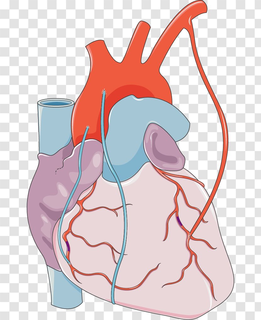 Coronary Artery Bypass Surgery Myocardial Infarction Cardiology Arteries - Frame - Anatomy Transparent PNG