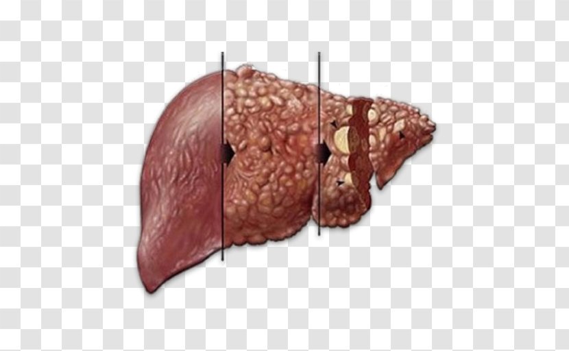 Liver Disease Hepatitis C Infectious - Cartoon - Flower Transparent PNG