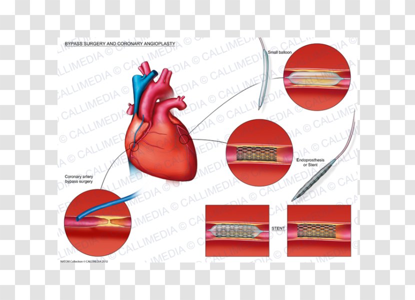 Angioplasty Heart Coronary Artery Bypass Surgery Stenting - Silhouette Transparent PNG