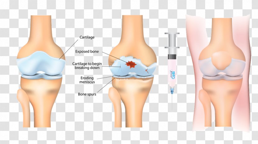 Stem-cell Therapy Osteoarthritis Platelet-rich Plasma Stem Cell Knee Arthritis - Silhouette - Health Transparent PNG