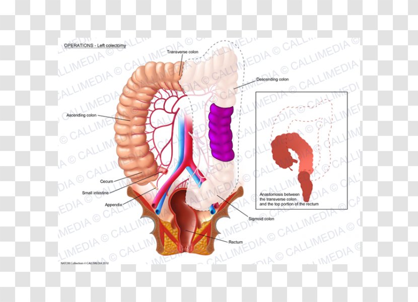 Colectomy Colorectal Cancer Rectum Lymph Node Surgery - Cartoon - Silhouette Transparent PNG