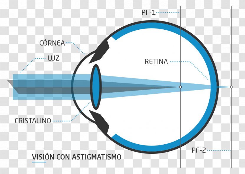 Floater Nd:YAG Laser Visual Perception Presbyopia Eye - Diagram Transparent PNG