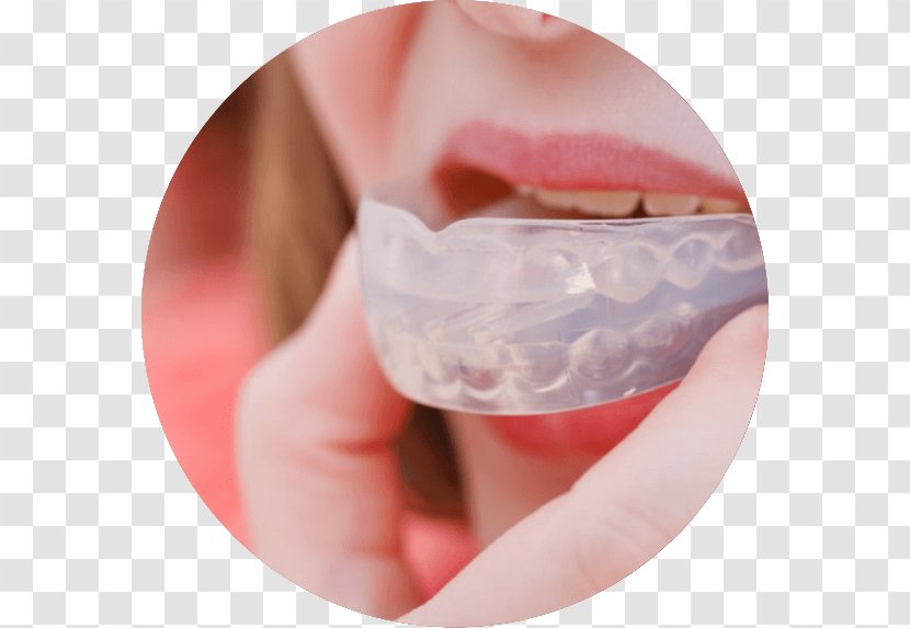 Mouthguard Bruxism Dentistry - Oral Hygiene - Orthodontic Correction Transparent PNG