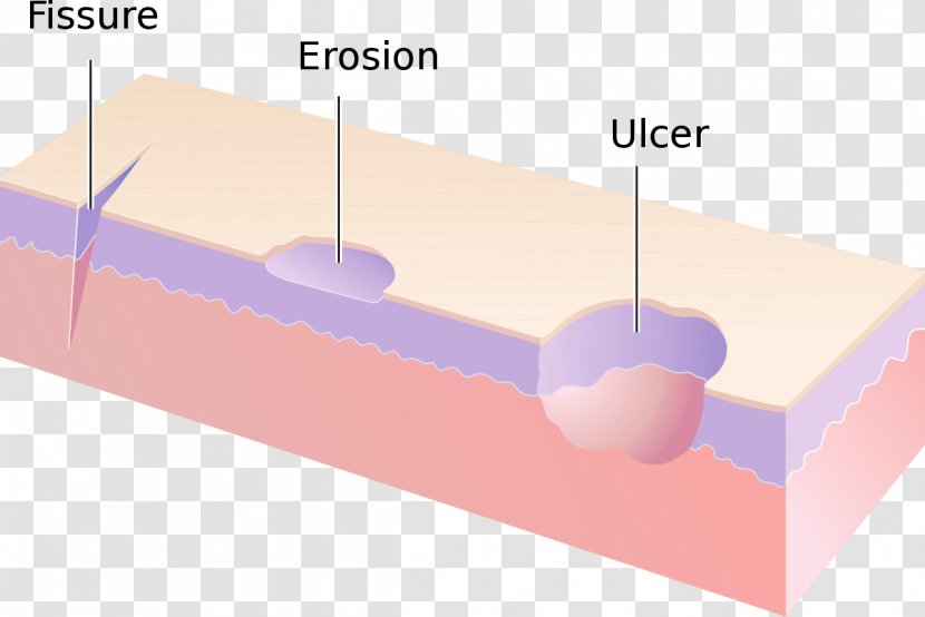 Erosion Dermatology Cutaneous Condition Skin Fissure Ulcer - Flower - Health Transparent PNG
