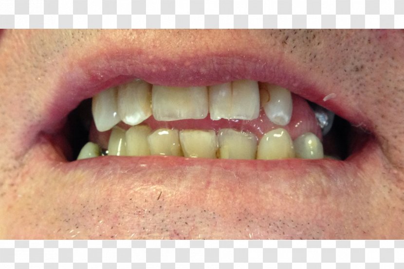 Close-up - Tongue - Orthodontics Surgery Transparent PNG