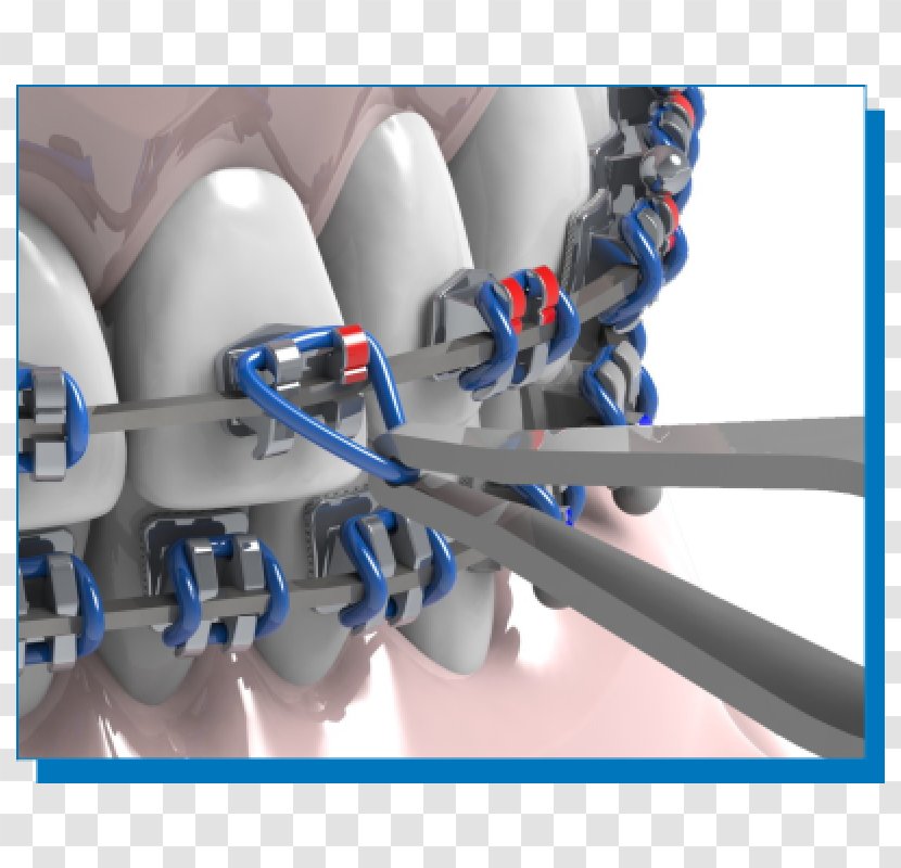 Clínica União Passos Orthodontics Dentistry Dental Braces - Ortodoncia Transparent PNG