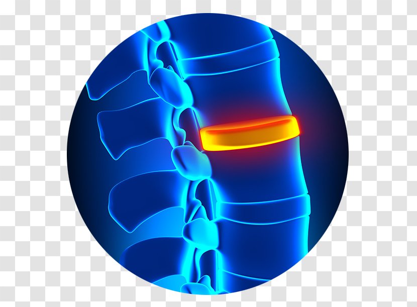 Spinal Disc Herniation Degenerative Disease Vertebral Column Orthopedic Surgery - Stenosis - Medicine Transparent PNG