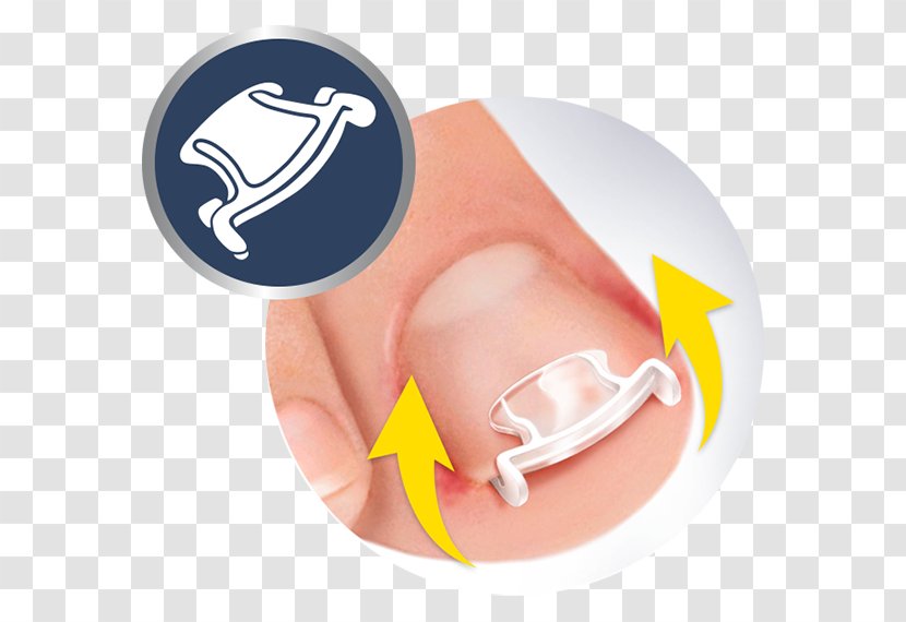 Onychocryptosis Nail Toe Dr. Scholl's Shoe - Pain Transparent PNG