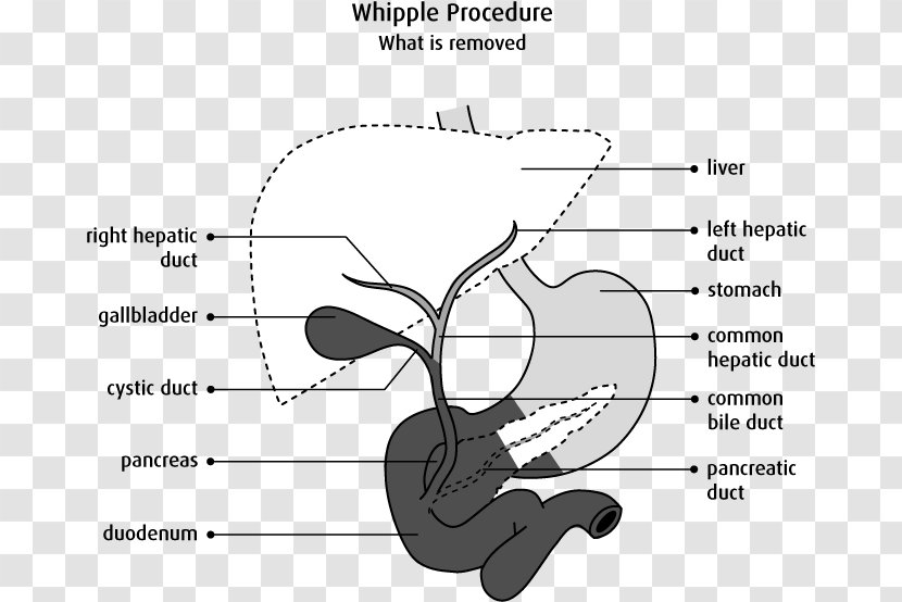 Pancreaticoduodenectomy Bile Duct Surgery Biliary Tract Pancreatic Cancer - Tree - Flower Transparent PNG