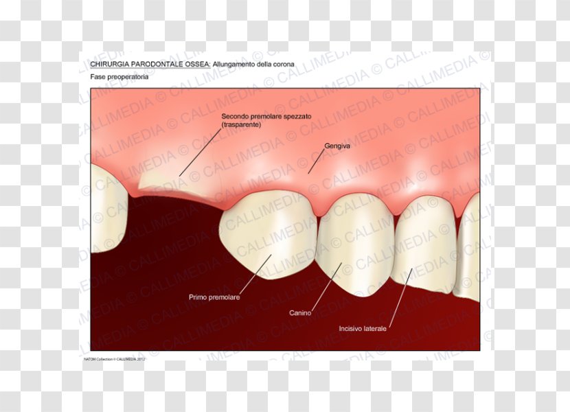Surgery Crown Lengthening Periodontal Disease Periodontology Medicine - Bone Grafting Transparent PNG