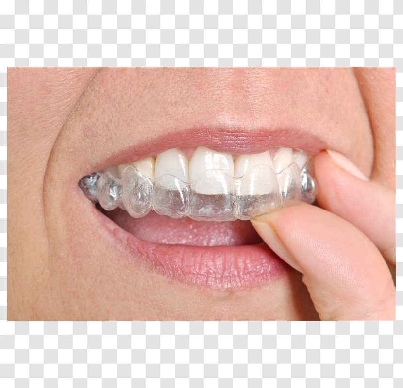 Clear Aligners Cosmetic Dentistry Orthodontics Dental Braces - Splint Transparent PNG