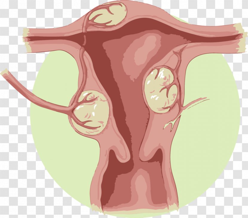 Uterine Fibroid Artery Embolization Uterus Benign Tumor - Watercolor - Silhouette Transparent PNG