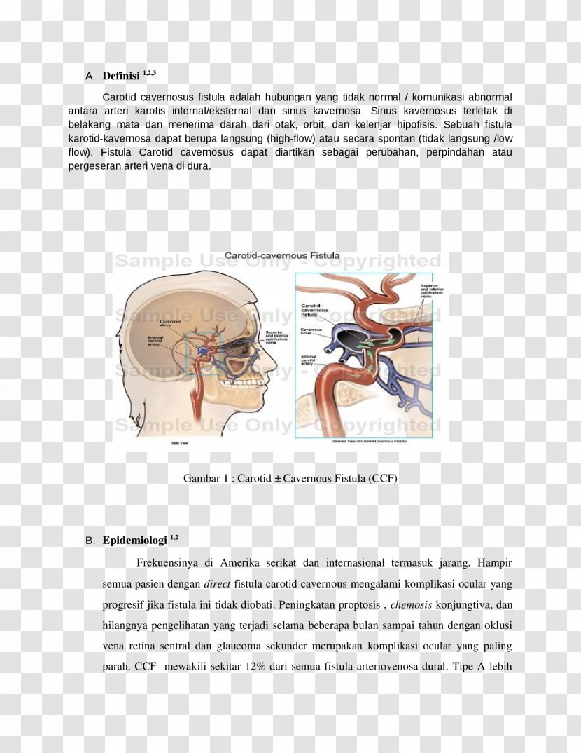 Cavernous Sinus Fistula - Frame Transparent PNG