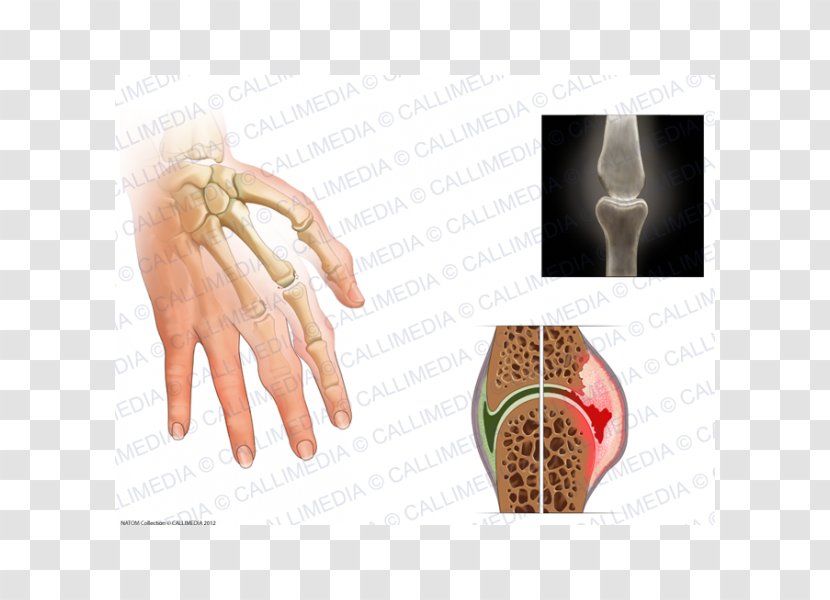 Rheumatoid Arthritis Chronic Childhood Disease Joint - Finger - Child Transparent PNG