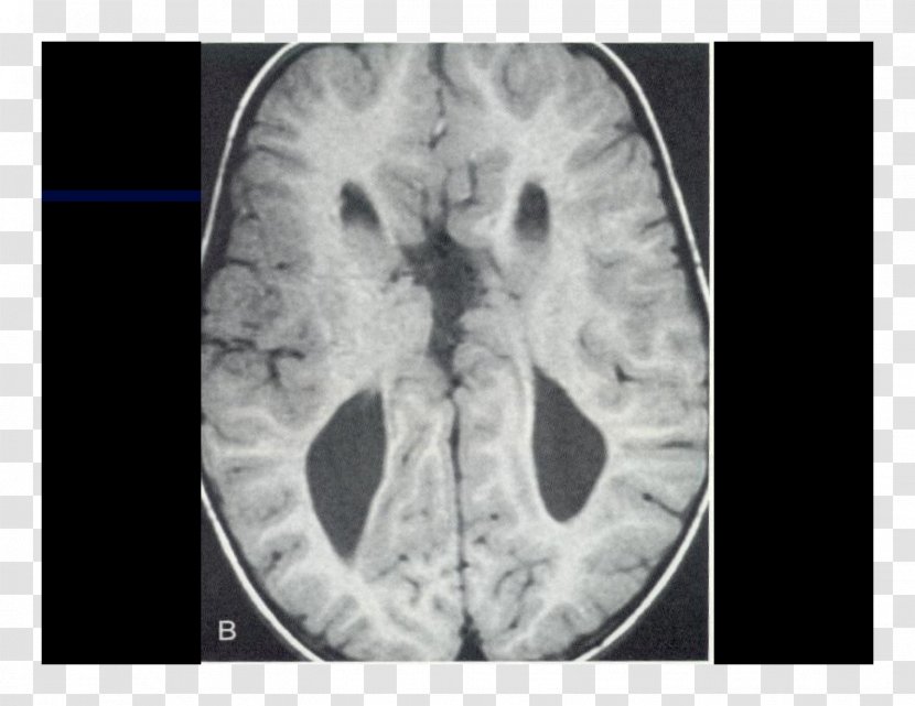 Computed Tomography Lääketieteellinen Röntgenkuvaus X-ray Brain Radiography - Cartoon Transparent PNG