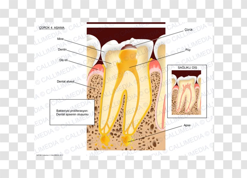 Dental Abscess Tooth Brushing Dentist - Cartoon - BACTERIA TOOTH Transparent PNG