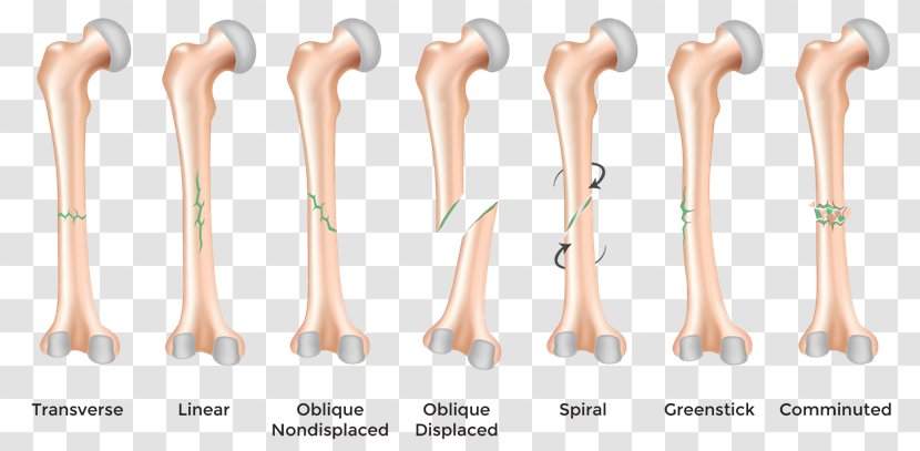 Bone Fracture Diagram Femoral Femur - Joint - Greenstick Transparent PNG