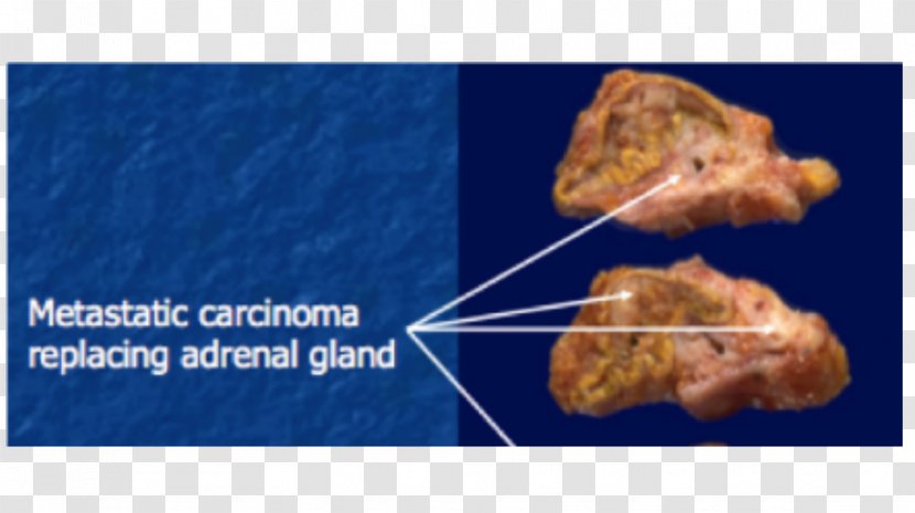 Adrenal Gland Cell Parathyroid Endocrine Pathology - Tissue Transparent PNG