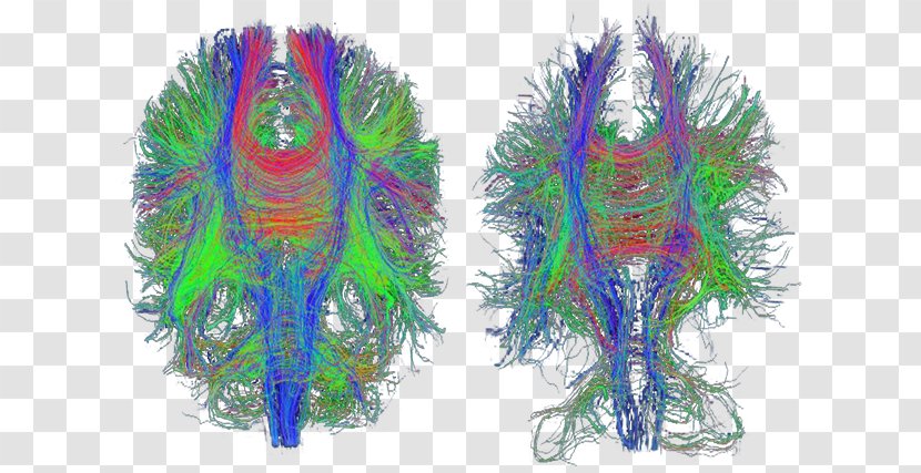 Traumatic Brain Injury Diffusion MRI Alzheimer's Disease Medical Imaging - Silhouette Transparent PNG