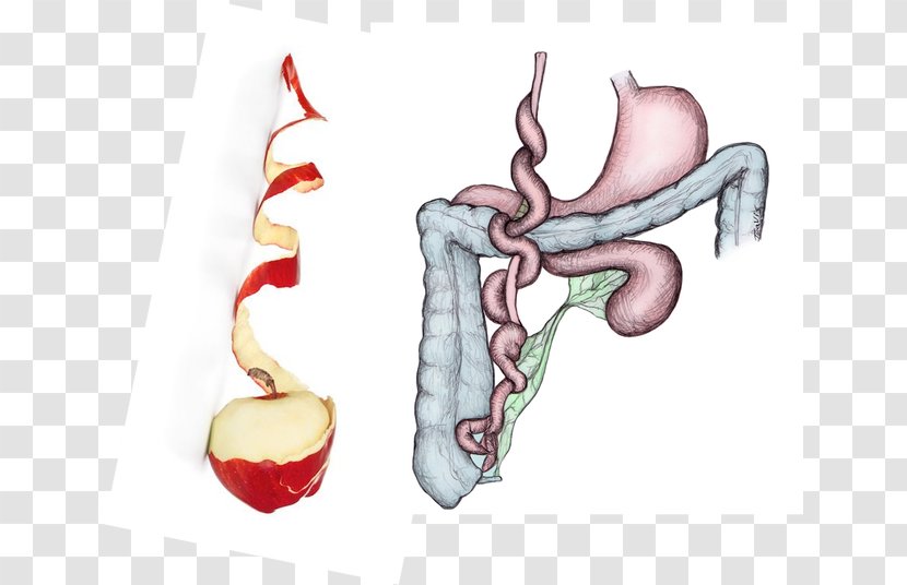 Intestinal Atresia Large Intestine Jejunum Stenosis - Heart Transparent PNG