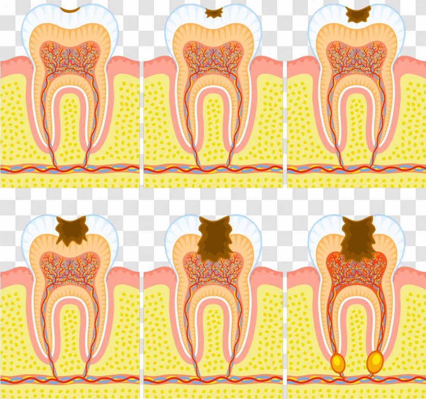 Tooth Decay Dentistry Pulp Human Dental Abscess - Heart - Frame Transparent PNG