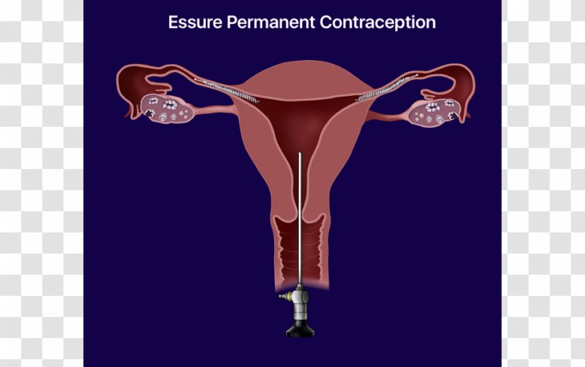 Essure Birth Control Sterilization Intrauterine Device Copper IUDs - Menstruation - Joint Transparent PNG