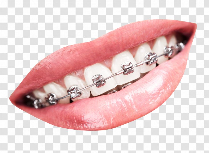 Tooth Dental Braces Dentistry - Smile - Teeth With Transparent PNG