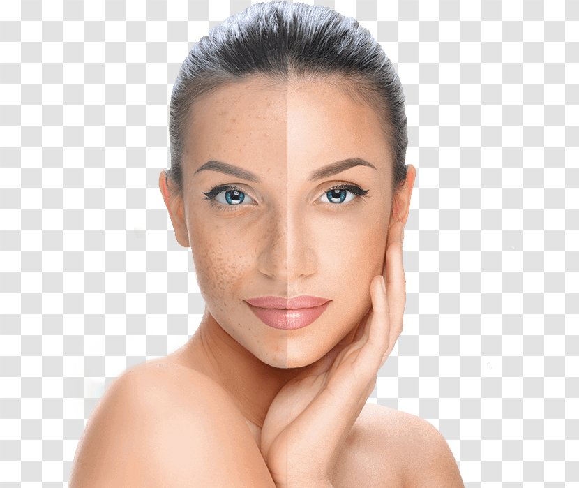 Chemical Peel Facial Skin Exfoliation Surgery - Care - Mulberry Transparent PNG