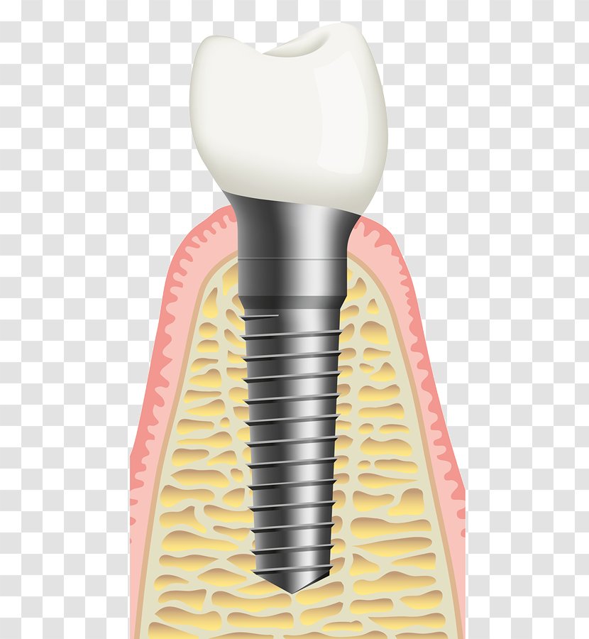 Bone Grafting Dental Implant Sinus Lift Dentist - Surgery - Implants Transparent PNG