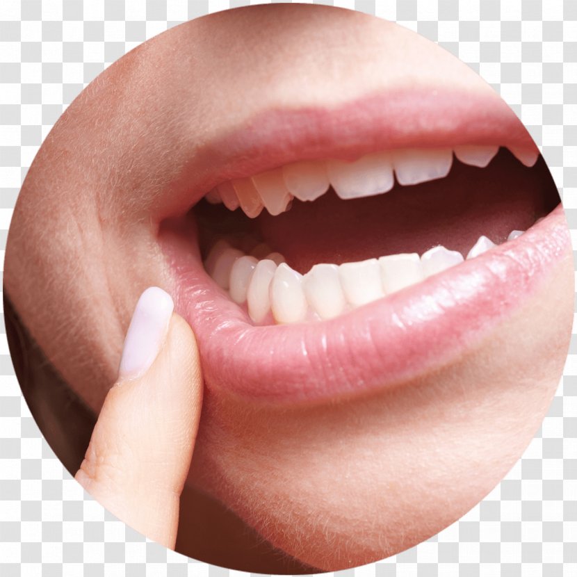 Aphthous Stomatitis Dentistry Mouth Ulcer Gums - Bleeding On Probing - Chewing Gum Transparent PNG