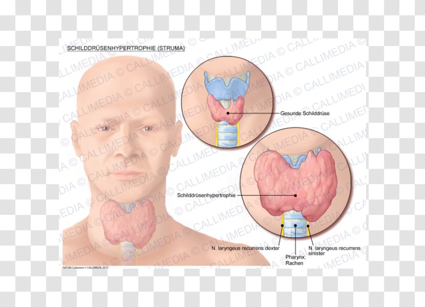 Goitre Thyroid Cancer Graves' Disease - Flower Transparent PNG